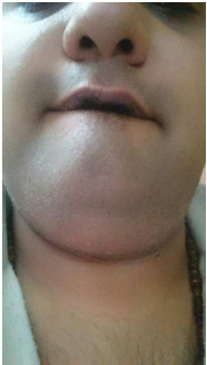 After-FUT-Follicular -Unit-Transplantation-Hair-Transplant-near-Bhayandar-Face-Value-Clinic